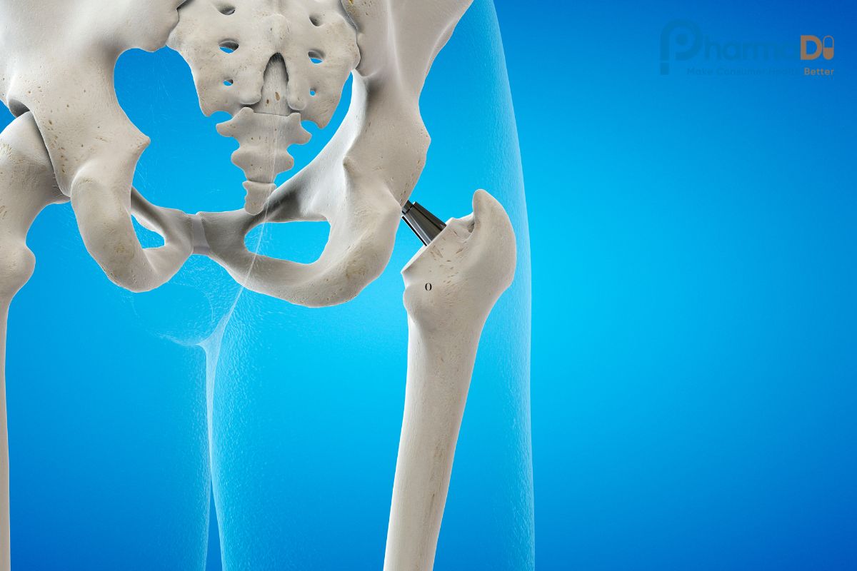 Thoái Hóa Khớp Háng: Dấu Hiệu Thường Gặp Và Cách điều Trị Khoa Học, Dược Sĩ Lưu ý