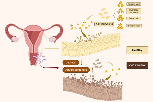 Có thể sử dụng men vi sinh phụ khoa để hỗ trợ điều trị viêm âm đạo