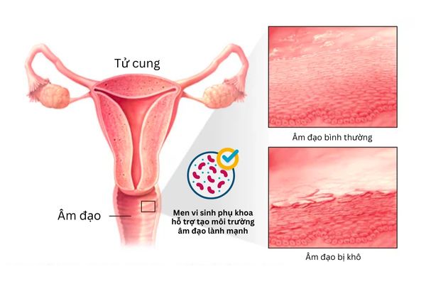 Men vi sinh phụ khoa hỗ trợ tạo môi trường thích hợp để lợi khuẩn phát triển