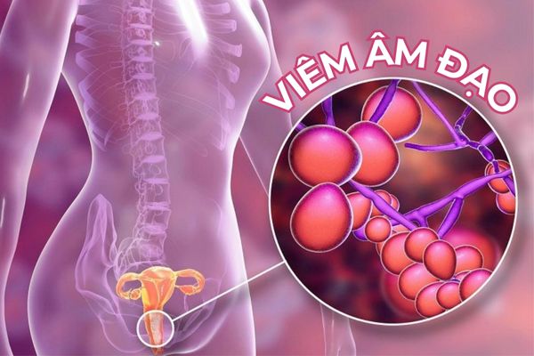 Viêm âm đạo là bệnh phụ khoa phổ biến nhất
