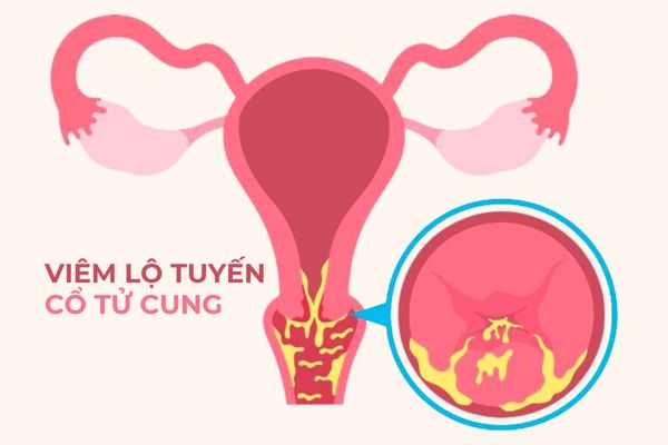 Viêm lộ tuyến cổ tử cung thường xuất hiện ở phụ nữ đã quan hệ hoặc sinh con