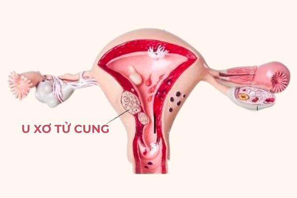 U xơ tử cung là khối u phụ khoa lành tính thường gặp ở phụ nữ độ tuổi sinh sản