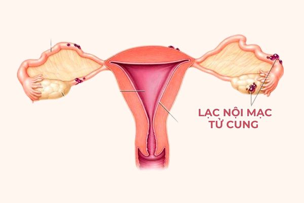 Các tế bào niêm mạc đi lạc khỏi buồng tử cung gây ra bệnh lạc nội mạc tử cung