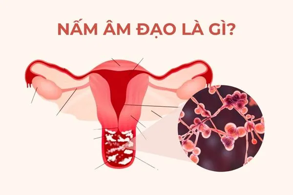 Âm đạo có thể bị viêm do nấm Candida gây ra bệnh nấm âm đạo