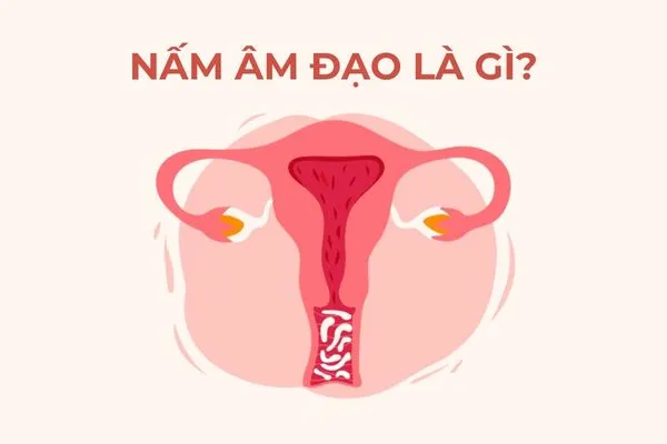 Nấm âm đạo là tình trạng viêm nhiễm thường gây ra bởi Candida albicans