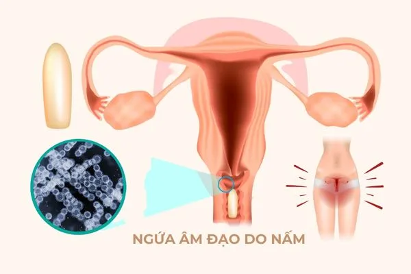Ngứa là dấu hiệu thường gặp ở chị em bị nấm âm đạo