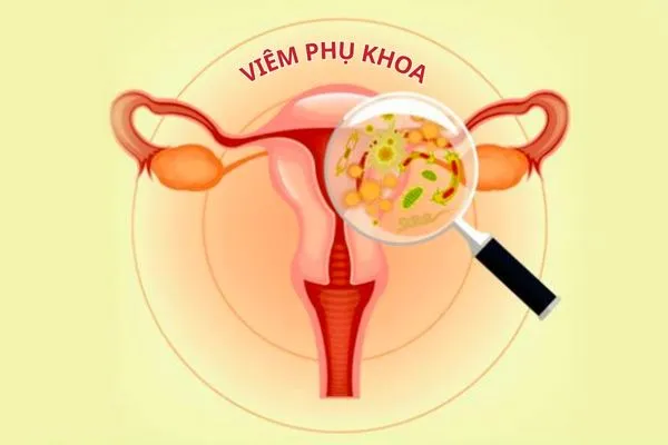 Viêm phụ khoa là tình trạng viêm nhiễm có nhiều dấu hiệu nhận biết