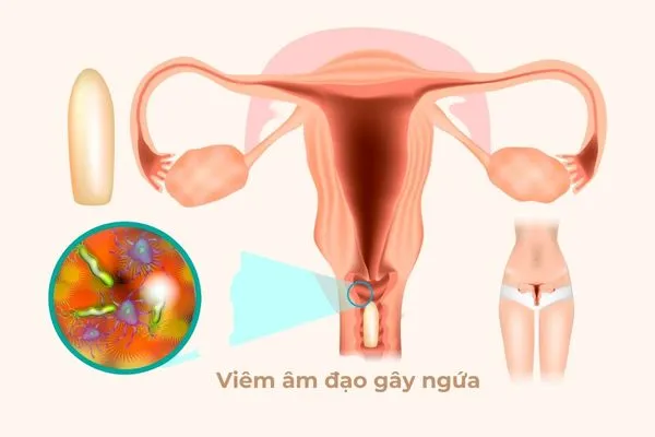 Viêm âm đạo là bệnh phụ khoa phổ biến có biểu hiện <yoastmark class=