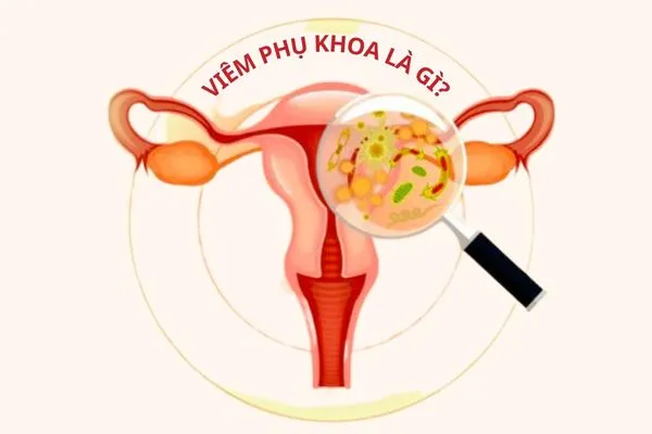 Viêm phụ khoa là bệnh phụ nữ phổ biến gây ảnh hưởng nhiều đến cuộc sống