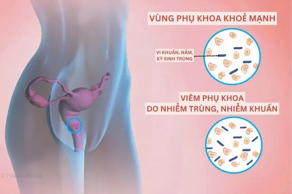Vi khuẩn, nấm, ký sinh trùng là tác nhân phổ biến gây viêm