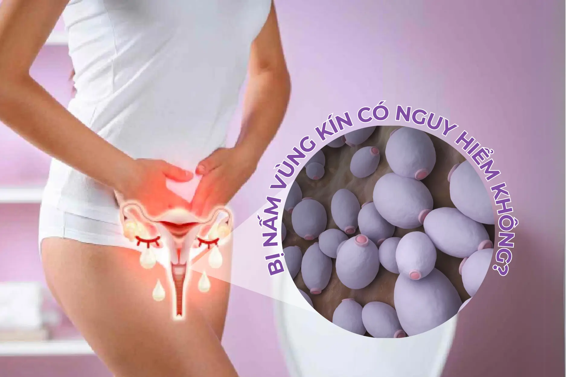 Bị nấm âm đạo không quá nguy hiểm nhưng vẫn cần điều trị kịp thời