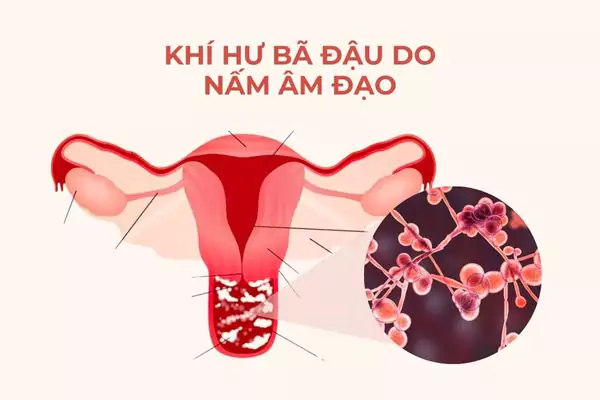 Nấm âm đạo là nguyên nhân hàng đầu gây nên triệu chứng này