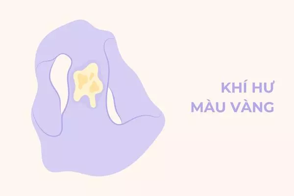 Khí hư màu vàng vẫn là bình thường nếu không kèm theo dấu hiệu bất thường khác