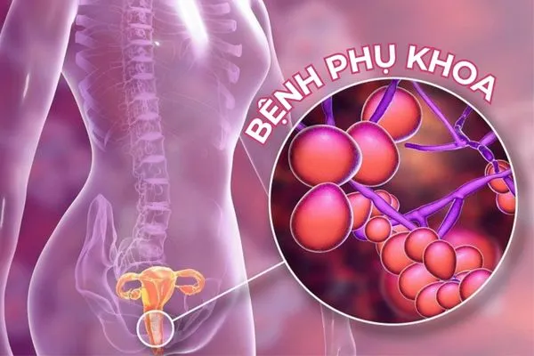 Các bệnh phụ khoa do hại khuẩn làm lợi khuẩn sụt giảm nghiêm trọng