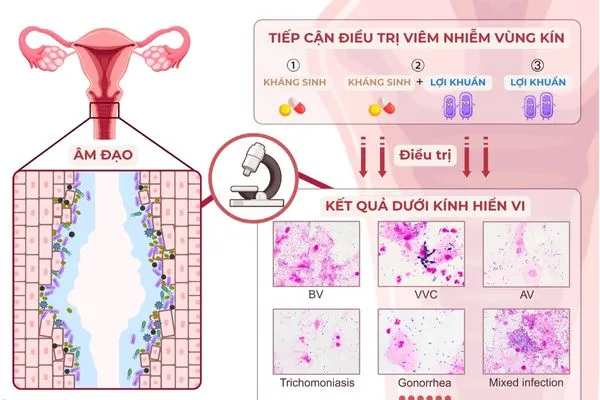 Nên dùng thuốc kháng sinh kết hợp với men vi sinh phụ khoa để bảo toàn lợi khuẩn