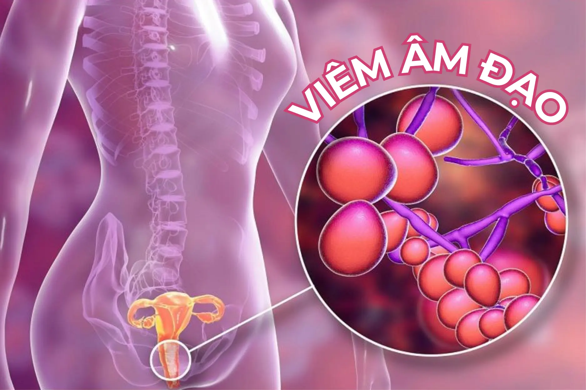 Viêm âm đạo là bệnh vùng kín phổ biến