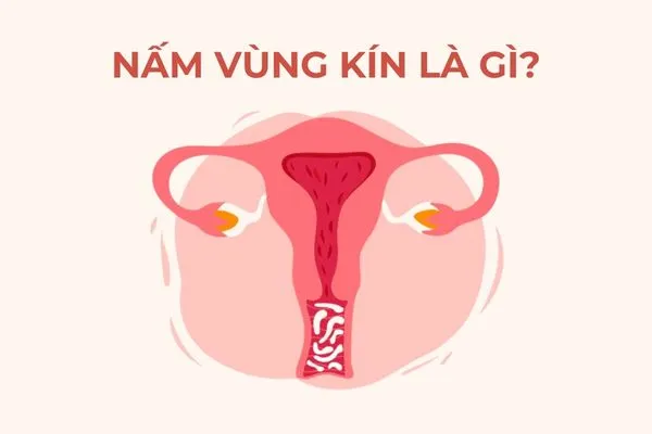 Candida albicans gây ra tình trạng viêm nhiễm tại âm đạo