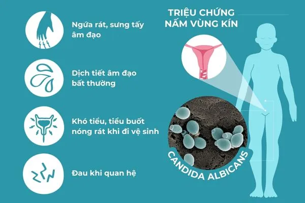 Ngứa âm đạo và tiết dịch trắng, vón cục là dấu hiệu nhiễm nấm điển hình