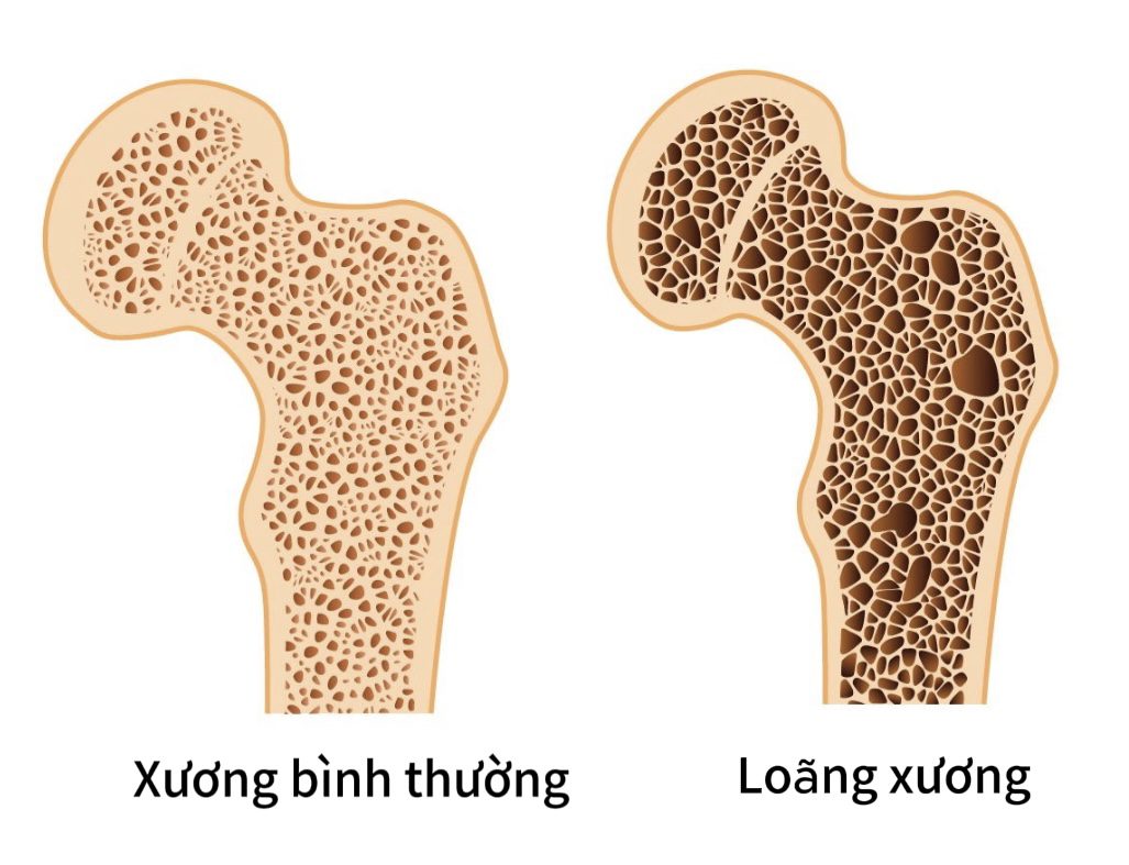 Các Vấn đề Xương Khớp Thường Gặp ở Người Cao Tuổi