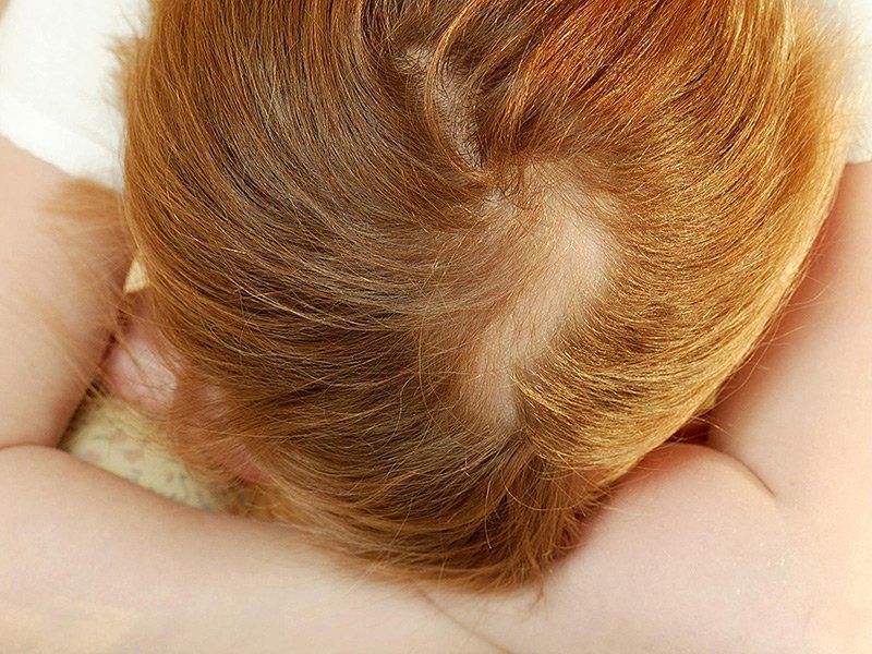 Rụng Tóc Nội Tiết Androgen