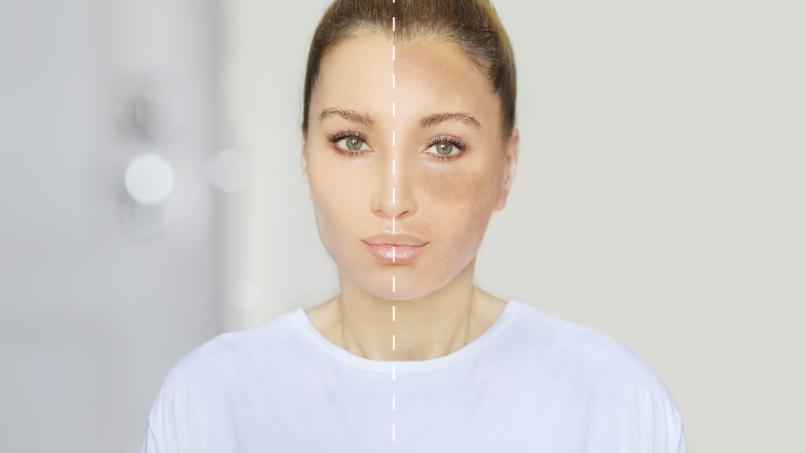 Nhau thai cừu giúp làm mờ các vết thâm, nám