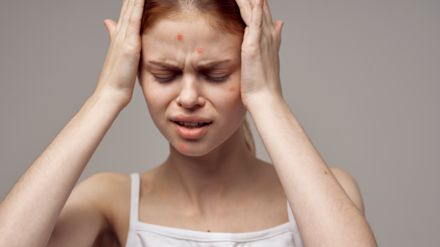 Sự tăng sản xuất dầu nhờn có thể gây ra mụn trứng cá ở một số người