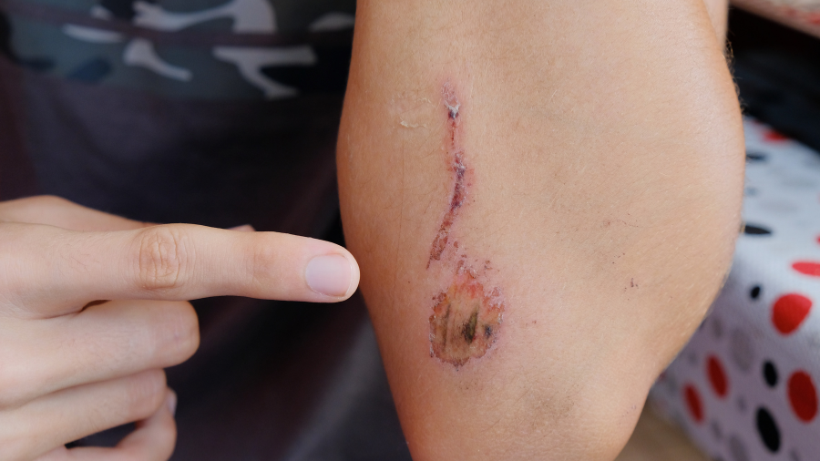 Da bị tổn thương, cơ thể tăng sản xuất axit hyaluronic để kích thích quá trình làm lành