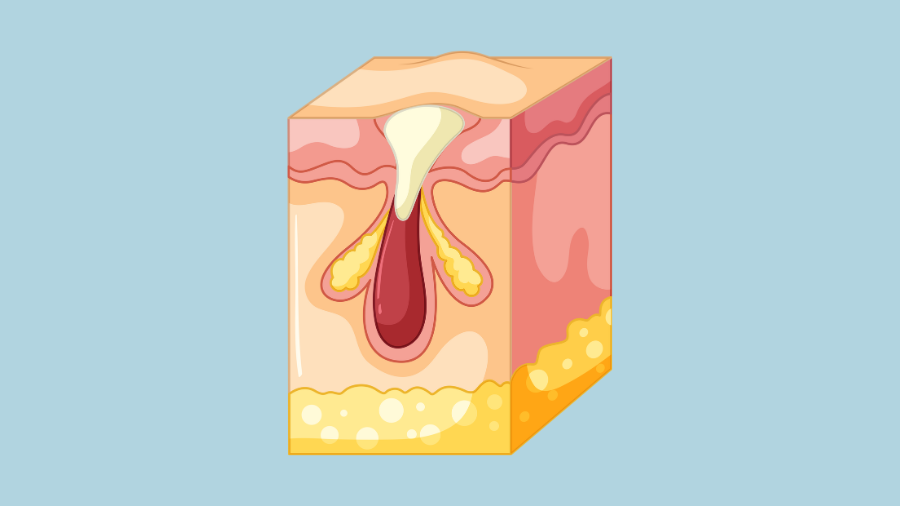 Mụn trứng cá thường xuất hiện trước hoặc trong kỳ kinh nguyệt do sự thay đổi hormone