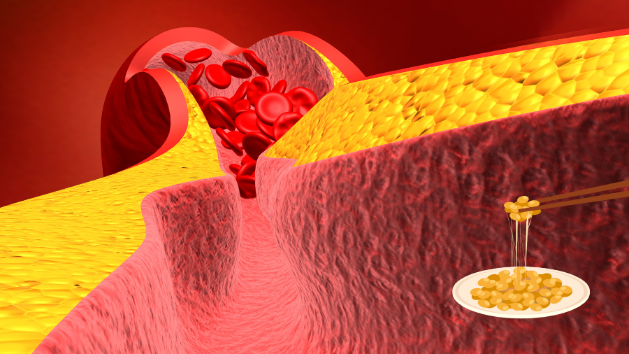 Nattokinase góp phần làm giảm các mảng xơ vữa động mạch, giảm mỡ máu và huyết áp
