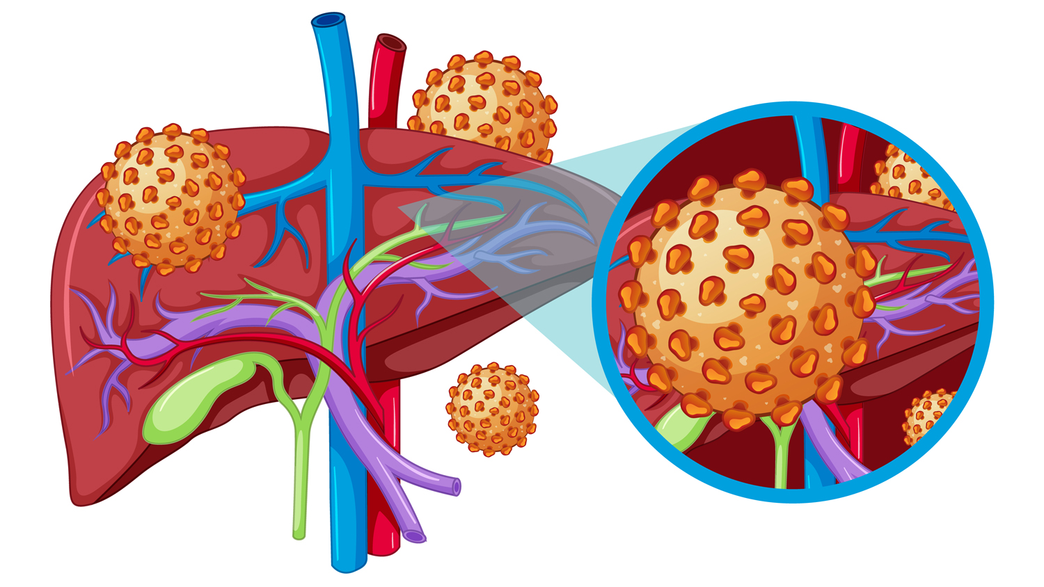 Bệnh gan mật phổ biến: Viêm gan B